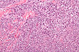 256px-Anaplastic_large_cell_lymphoma_-_high_mag